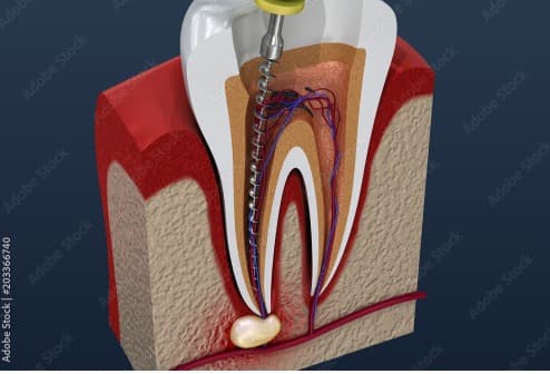 Root canal treatment