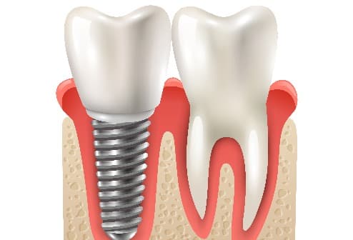 Dental Implants