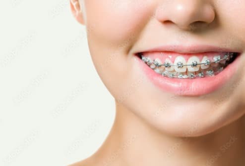 Orthodontic Treatment