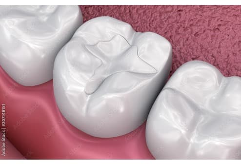 Dental Fillings