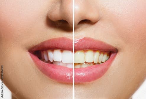 Teeth whitening.
