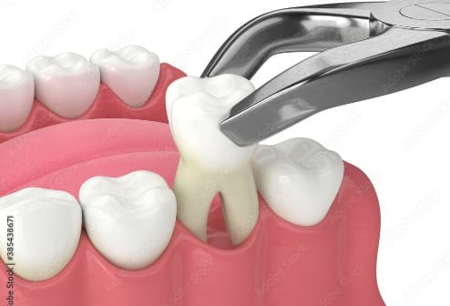 Tooth Extractions