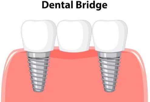 Dental Crown and Bridges